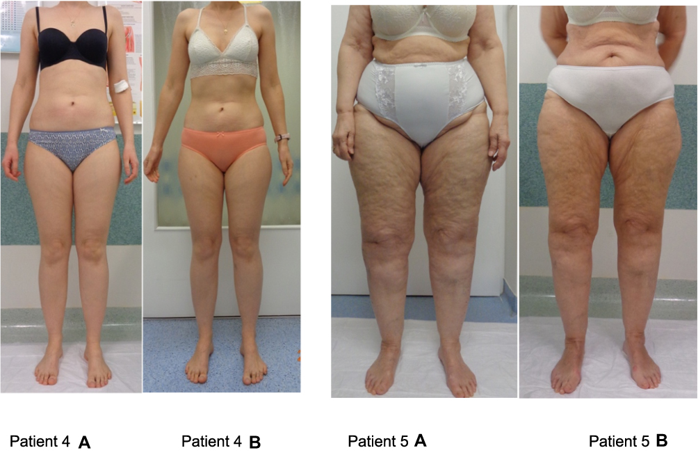 Natural Ways to Manage Lipedema and Promote Weight Loss